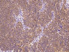 E6AP / UBE3A Antibody - Immunochemical staining of human UBE3A in human ovarian cancer with rabbit polyclonal antibody at 1:300 dilution, formalin-fixed paraffin embedded sections.