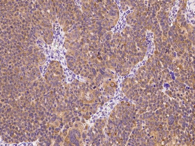 E6AP / UBE3A Antibody - Immunochemical staining of human UBE3A in human ovarian cancer with rabbit polyclonal antibody at 1:300 dilution, formalin-fixed paraffin embedded sections.