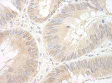 EAF2 / U19 Antibody - Detection of Human EAF2 by Immunohistochemistry. Sample: FFPE section of human colon carcinoma. Antibody: Affinity purified rabbit anti-EAF2 used at a dilution of 1:250.