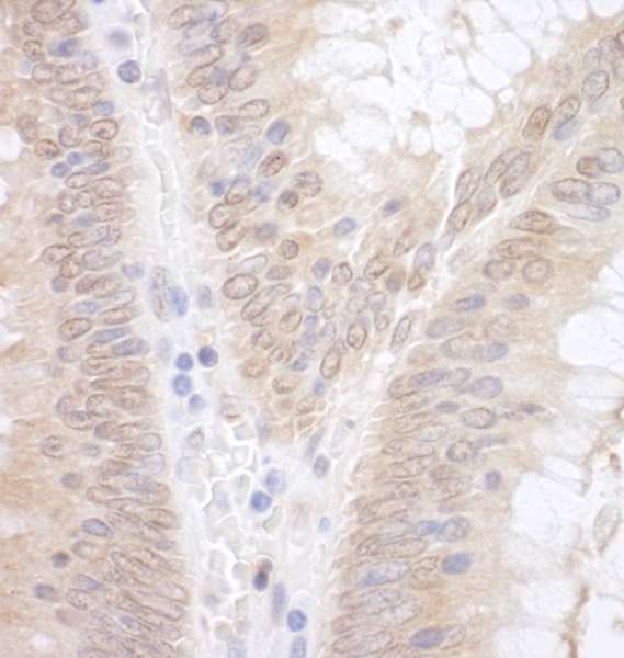 EAF2 / U19 Antibody - Detection of Human EAF2 by Immunohistochemistry. Sample: FFPE section of human colon carcinoma. Antibody: Affinity purified rabbit anti-EAF2 used at a dilution of 1:1000 (1 Detection: DAB.
