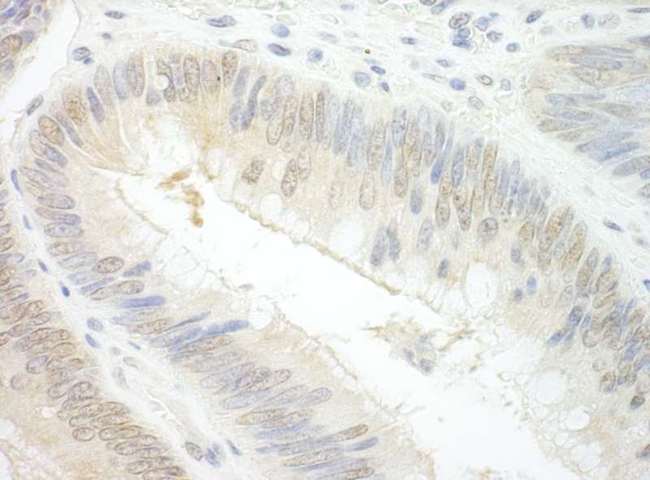 EAF2 / U19 Antibody - Detection of Human EAF2 by Immunohistochemistry. Sample: FFPE section of human colon carcinoma. Antibody: Affinity purified rabbit anti-EAF2 used at a dilution of 1:1000 (1 Detection: DAB.