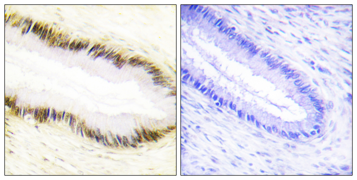 EAR2 / NR2F6 Antibody - Immunohistochemistry analysis of paraffin-embedded human cervix carcinoma tissue, using NR2F6 Antibody. The picture on the right is blocked with the synthesized peptide.