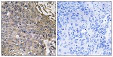 EAT2 / SH2D1B Antibody - Immunohistochemistry analysis of paraffin-embedded human lung carcinoma, using SH2D1B Antibody. The picture on the right is blocked with the synthesized peptide.
