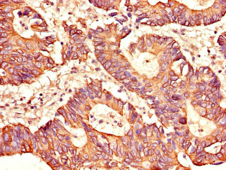 EAT2 / SH2D1B Antibody - Immunohistochemistry of paraffin-embedded human colon cancer using SH2D1B Antibody at dilution of 1:100