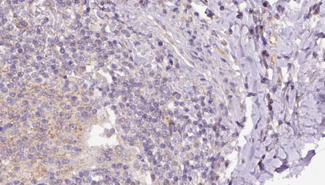 EAT2 / SH2D1B Antibody - 1:100 staining human lymph carcinoma tissue by IHC-P. The sample was formaldehyde fixed and a heat mediated antigen retrieval step in citrate buffer was performed. The sample was then blocked and incubated with the antibody for 1.5 hours at 22°C. An HRP conjugated goat anti-rabbit antibody was used as the secondary.