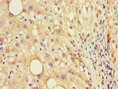 EBI3 / IL-27B Antibody - Immunohistochemistry of paraffin-embedded human liver cancer using EBI3 Antibody at dilution of 1:100