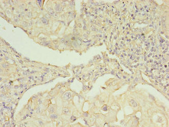 EBP Antibody - Immunohistochemistry of paraffin-embedded human lung cancer using EBP Antibody at dilution of 1:100