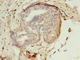 EBP Antibody - Immunohistochemistry of paraffin-embedded human breast cancer using antibody at 1:100 dilution.  This image was taken for the unconjugated form of this product. Other forms have not been tested.