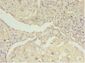 EBP Antibody - Immunohistochemistry of paraffin-embedded human lung cancer using antibody at 1:100 dilution.  This image was taken for the unconjugated form of this product. Other forms have not been tested.