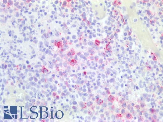 EBV LMP Antibody - Human Tonsil, Lymphocytes Infected by Epstein Barr Virus: Formalin-Fixed, Paraffin-Embedded (FFPE)