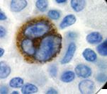 EBV LMP Antibody - IHC of Epstein Barr Virus on FFPE Hodgkin's Lymphoma tissue. This image was taken for the unmodified form of this product. Other forms have not been tested.