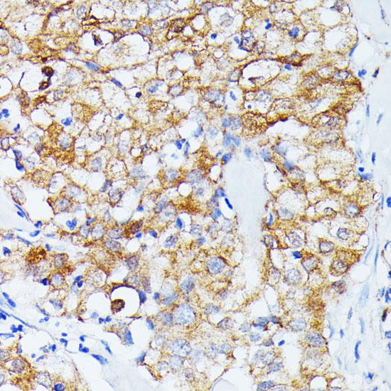 ECE-1 Antibody - Immunohistochemistry of paraffin-embedded Human mammary cancer using ECE1 Polyclonal Antibody at dilution of 1:100 (40x lens).