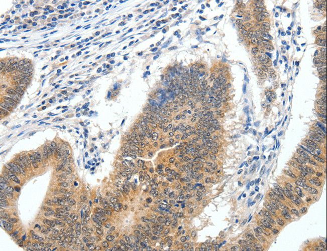 ECE2 Antibody - Immunohistochemistry of paraffin-embedded Human gastric cancer using ECE2 Polyclonal Antibody at dilution of 1:40.