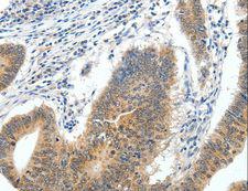 ECE2 Antibody - Immunohistochemistry of paraffin-embedded Human gastric cancer using ECE2 Polyclonal Antibody at dilution of 1:40.
