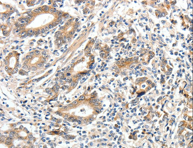 ECE2 Antibody - Immunohistochemistry of paraffin-embedded Human gastric cancer using ECE2 Polyclonal Antibody at dilution of 1:40.