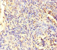 ECEL1 Antibody - Immunohistochemistry of paraffin-embedded human cervical cancer at dilution of 1:100