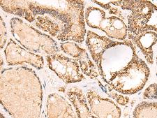 ECH1 Antibody - Immunohistochemistry of paraffin-embedded Human thyroid cancer tissue  using ECH1 Polyclonal Antibody at dilution of 1:50(×200)