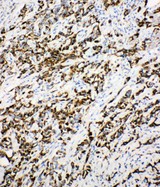 ECI1 / DCI Antibody - DCI / ECI1 antibody. IHC(P): Human Breast Cancer Tissue.