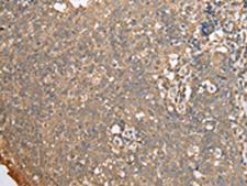 ECI1 / DCI Antibody - Immunohistochemistry of paraffin-embedded Human cervical cancer tissue  using ECI1 Polyclonal Antibody at dilution of 1:30(×200)
