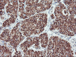 ECI2 / PECI Antibody - IHC of paraffin-embedded Carcinoma of Human liver tissue using anti-PECI mouse monoclonal antibody. (Heat-induced epitope retrieval by 10mM citric buffer, pH6.0, 100C for 10min).