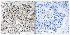 ECI2 / PECI Antibody - Peptide - + Immunohistochemistry analysis of paraffin-embedded human breast carcinoma tissue using PECI antibody.