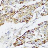 ECI2 / PECI Antibody - Immunohistochemistry of paraffin-embedded Human liver cancer using ECI2 Polyclonal Antibody at dilution of 1:150 (40x lens).