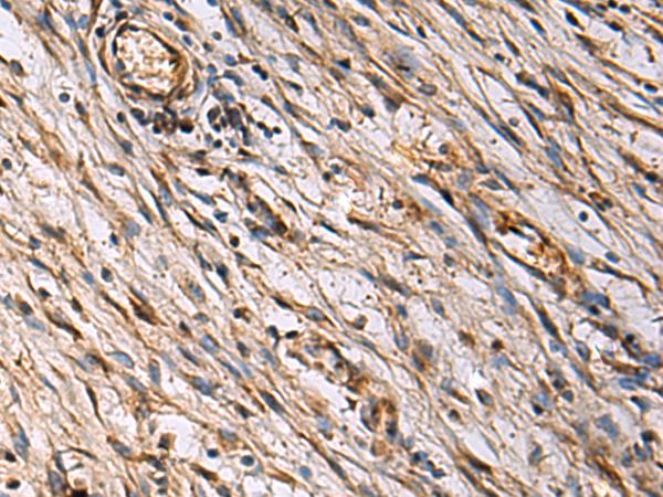 ECM1 Antibody - Immunohistochemistry of paraffin-embedded Human colorectal cancer tissue  using ECM1 Polyclonal Antibody at dilution of 1:25(×200)
