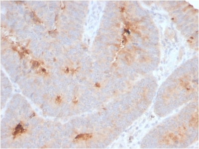 ECM1 Antibody - Formalin-fixed, paraffin-embedded human Colon Carcinoma stained with Secretory Component Rabbit Recombinant Monoclonal (ECM1/2889R).