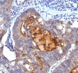 ECM1 Antibody - Formalin-fixed, paraffin-embedded human colon carcinoma stained with Secretory Component Glycoprotein antibody (ECM1/792).  This image was taken for the unmodified form of this product. Other forms have not been tested.