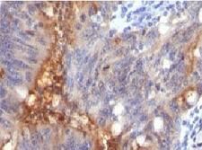 ECM1 Antibody - IHC testing of human colon carcinoma and Secretory Component Glycoprotein antibody (SRGP85).  This image was taken for the unmodified form of this product. Other forms have not been tested.