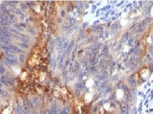ECM1 Antibody - IHC testing of human colon carcinoma and Secretory Component Glycoprotein antibody (SRGP85).  This image was taken for the unmodified form of this product. Other forms have not been tested.