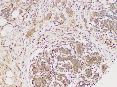 ECM1 Antibody - Immunohistochemistry of paraffin-embedded Human breast cancer using ECM1 Polycloanl Antibody at dilution of 1:300