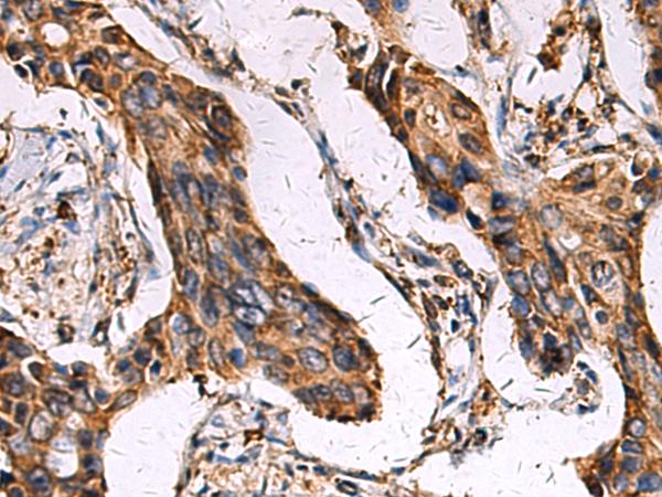 ECM1 Antibody - Immunohistochemistry of paraffin-embedded Human breast cancer tissue  using ECM1 Polyclonal Antibody at dilution of 1:45(×200)