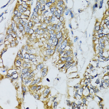 ECSIT Antibody - Immunohistochemistry of paraffin-embedded human gastric cancer tissue.