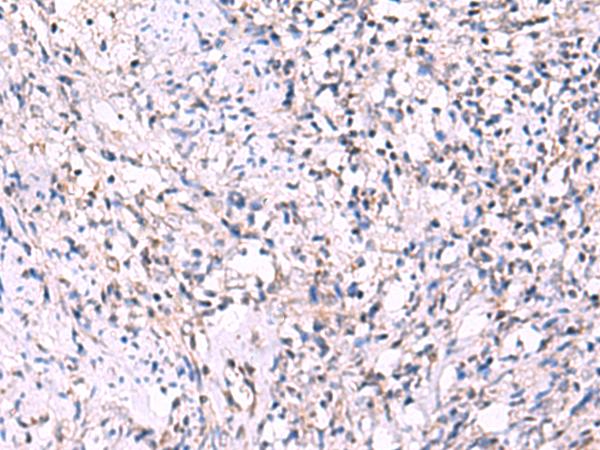 ECSIT Antibody - Immunohistochemistry of paraffin-embedded Human cervical cancer tissue  using ECSIT Polyclonal Antibody at dilution of 1:70(×200)