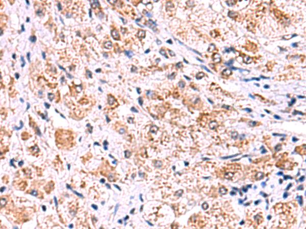 ECSIT Antibody - Immunohistochemistry of paraffin-embedded Human liver cancer tissue  using ECSIT Polyclonal Antibody at dilution of 1:75(×200)