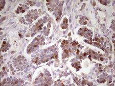 ECT2 Antibody - Immunohistochemical staining of paraffin-embedded Adenocarcinoma of Human ovary tissue using anti-ECT2 mouse monoclonal antibody. (Heat-induced epitope retrieval by 1 mM EDTA in 10mM Tris, pH8.5, 120C for 3min,