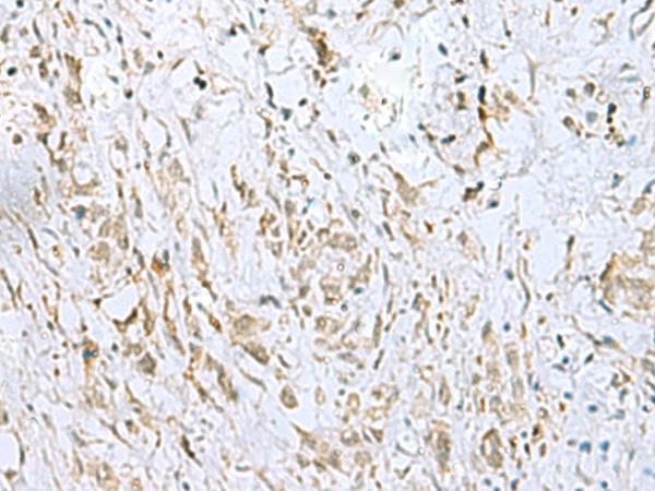 ECT2 Antibody - Immunohistochemistry of paraffin-embedded Human gastric cancer tissue  using ECT2 Polyclonal Antibody at dilution of 1:35(×200)
