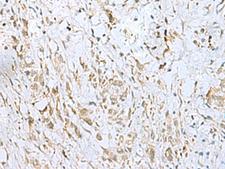 ECT2 Antibody - Immunohistochemistry of paraffin-embedded Human gastric cancer tissue  using ECT2 Polyclonal Antibody at dilution of 1:35(×200)