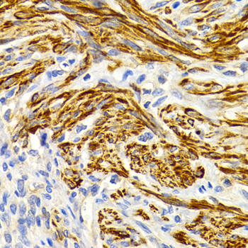 EDA / Ectodysplasin A Antibody - Immunohistochemistry of paraffin-embedded human metrocarcinoma tissue.