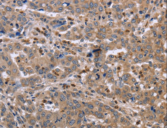 EDA / Ectodysplasin A Antibody - Immunohistochemistry of paraffin-embedded Human cervical cancer using EDA Polyclonal Antibody at dilution of 1:30.