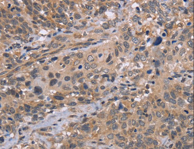 EDA / Ectodysplasin A Antibody - Immunohistochemistry of paraffin-embedded Human cervical cancer using EDA Polyclonal Antibody at dilution of 1:30.