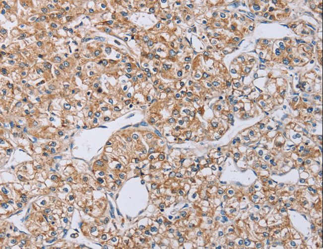 EDA / Ectodysplasin A Antibody - Immunohistochemistry of paraffin-embedded Human prostate cancer using EDA Polyclonal Antibody at dilution of 1:40.