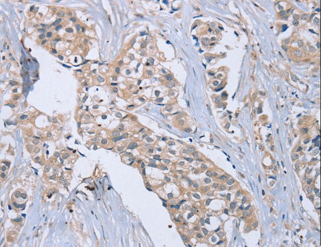 EDA / Ectodysplasin A Antibody - Immunohistochemistry of paraffin-embedded Human breast cancer using EDA Polyclonal Antibody at dilution of 1:40.
