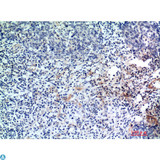 EDA / Ectodysplasin A Antibody - Immunohistochemistry (IHC) analysis of paraffin-embedded Human Breast Cancer, antibody was diluted at 1:200.