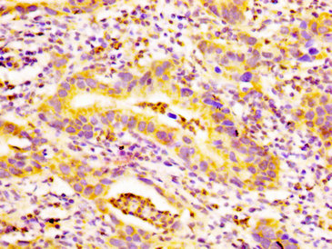 EDAR Antibody - Immunohistochemistry image at a dilution of 1:500 and staining in paraffin-embedded human bladder cancer performed on a Leica BondTM system. After dewaxing and hydration, antigen retrieval was mediated by high pressure in a citrate buffer (pH 6.0) . Section was blocked with 10% normal goat serum 30min at RT. Then primary antibody (1% BSA) was incubated at 4 °C overnight. The primary is detected by a biotinylated secondary antibody and visualized using an HRP conjugated SP system.