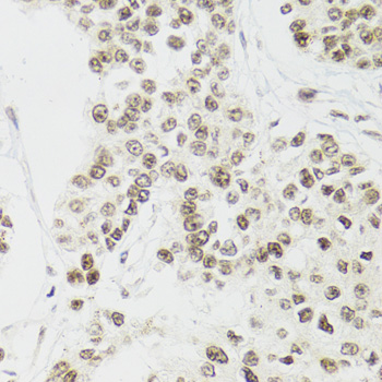 EDF1 / MBF1 Antibody - Immunohistochemistry of paraffin-embedded mouse esophageal cancer tissue.