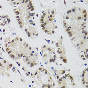 EDF1 / MBF1 Antibody - Immunohistochemistry of paraffin-embedded human gastric cancer tissue.