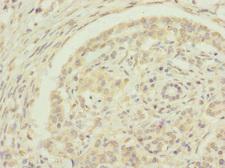 EDIL3 / DEL1 Antibody - Immunohistochemistry of paraffin-embedded human pancreatic cancer at dilution 1:100