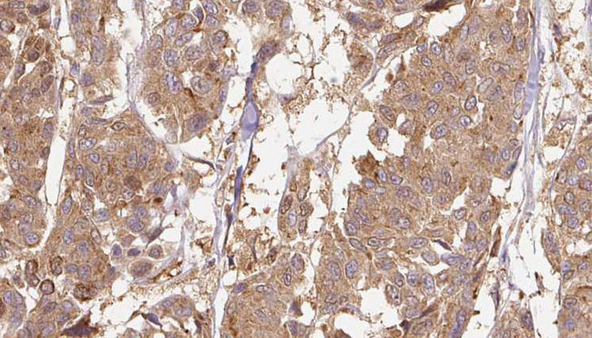 EDIL3 / DEL1 Antibody - 1:100 staining human Melanoma tissue by IHC-P. The sample was formaldehyde fixed and a heat mediated antigen retrieval step in citrate buffer was performed. The sample was then blocked and incubated with the antibody for 1.5 hours at 22°C. An HRP conjugated goat anti-rabbit antibody was used as the secondary.